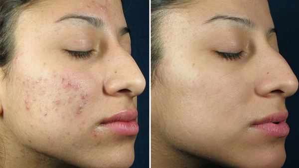 chemical peel