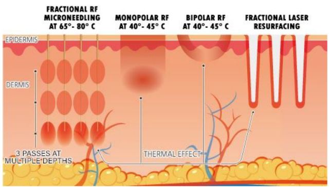 RF microneedling