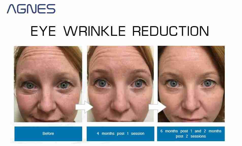 Agnes Precision Rf Microneedling