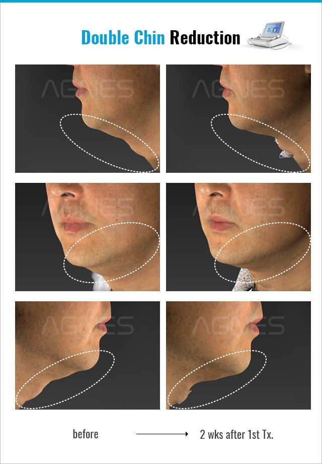 Agnes Precision RF Microneedling