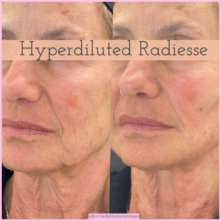 Hyperdilute Radiesse face before and after