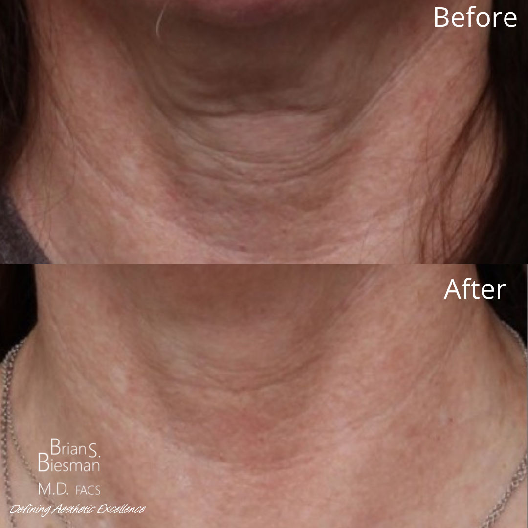 Hyperdilute Radiesse neck before and after